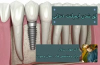 راه های نگهداری و مراقبت از ایمپلنت دندان