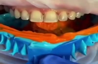 قالب گیری از دندانها با خمیر مخصوص دندانپزشکی
