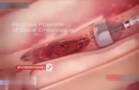 انیمیشنی جالب از نحوه برداشتن لخته خون از داخل رگ