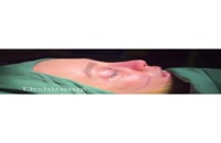 جراحی بینی و تزریق چربی زیباجوی کلینیک دکتر شیرنگی