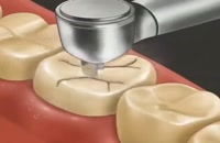 برداشت پوسیدگی و ترمیم برای دندان