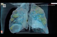 تصاویر سه بعدی تاثیر ویروس کرونا بر ریه های انسان