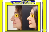 نمونه کار قبل و بعد جراحی زیبایی بینی در گرگان