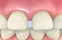 بستن فاصله دندانها