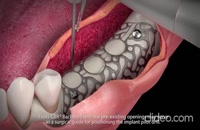 ایمپلنت دندان با پیوند استخوان