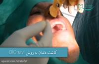 ایمپلنت دندان به روش DIOnavi