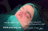 نتیجه عمل بینی طبیعی در آقایان - بهترین جراح بینی در تهران