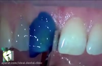 فیلم مراحل کامپوزیت دندان