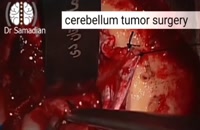 عمل جراحی تومور مخچه