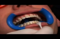نحوه ی سفید کردن دندان