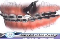 درمان دندان نیش نهفته با استفاده از ارتودنسی