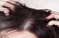 رفع شوره سر با محصول ضد شوره و خارش جی اف لازارتیگ مناسب انواع مو