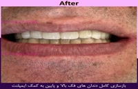 بازسازی کامل دندان های فک های بالا و پایین