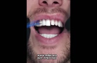 لمینت کردن دندان چگونه انجام می شود/فیلم