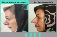 انجام جراحی بینی برای زیباجوی عزیز توسط دکتر پژمان سرشارزاده