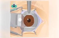 LASIK Surgery Step by Step