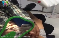 عصب کشی دندان کودک در تهران