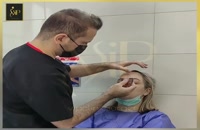 کانتوپلاستی (عمل چشم گربه ای) توسط دکتر خوانساری-کلینیک vip تهران
