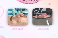 انجام عمل بینی مردانه توسط یکی از بهترین جراحان زیبایی تهران