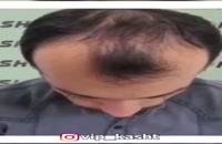 نتیجه کاشت مو بعد از 2 سال در کلینیک vip تهران