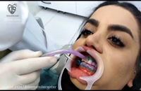 سفید کردن و بلیچینگ دندان با لیزرتراپی