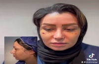 فیلم قبل و بعد از جراحی بینی طبیعی دکتر سعید شیرنگی