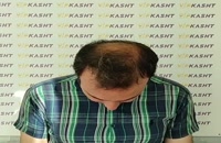 نتیجه 10 ماه بعد از کاشت مو به روش میکرو sut- کلینیک vip تهران