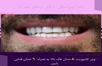 انجام ونیر کامپوزیت چهارده دندان برای زیباجوی عزیز