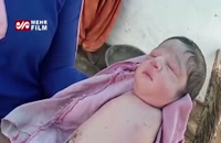 به دنیا آمدن نوزاد بدون دست و پا در هند
