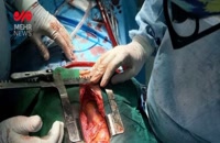 عمل جراحی بای پس عروق کرونر قلب در شاهرود
