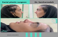انجام جراحی نیمه فانتزی بینی برای زیباجو عزیز توسط دکتر پژمان سرشارزاده