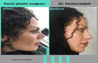 انجام جراحی بینی برای زیباجوی عزیز توسط دکتر پژمان سرشارزاده